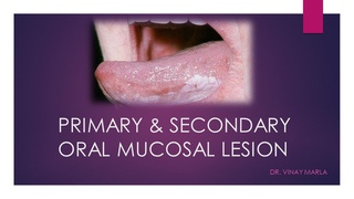 Primary & Secondary Oral Mucosal Lesion